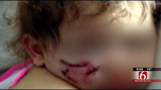 Tulsa Child Recovering Following Dog Bite To Face