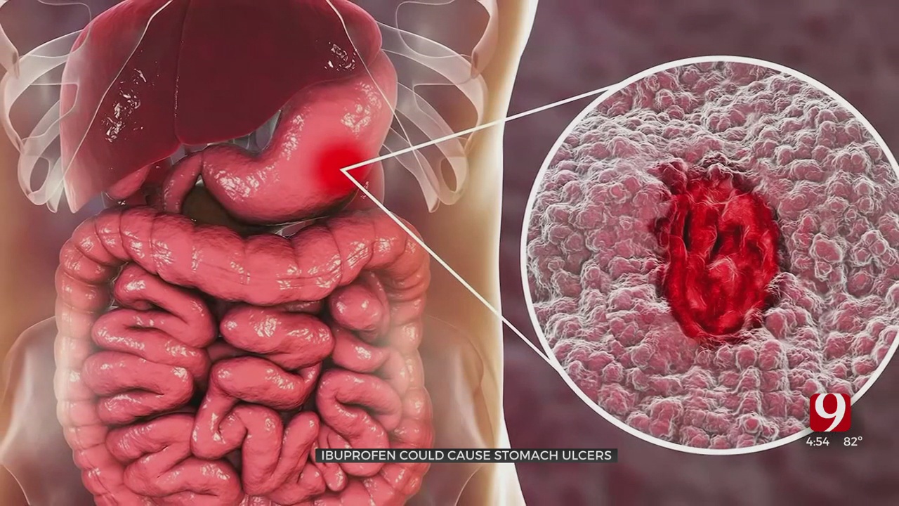 Medical Minute: Ibuprofen Could Cause Stomach Ulcers 