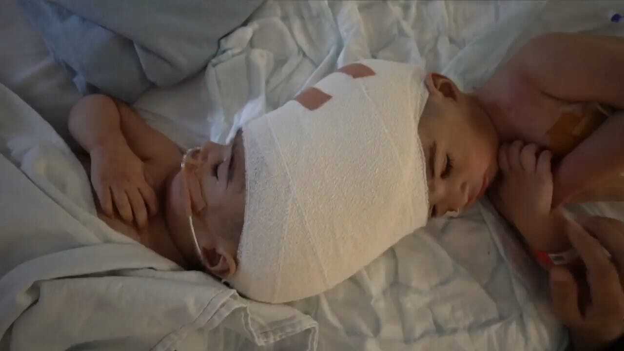 Doctors Separate Conjoined Twins Through Virtual Reality, 3D Printing