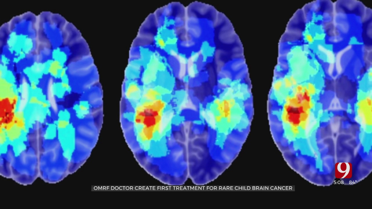 Oklahoma Doctors Celebrate Potential Breakthrough In Brain Cancer Treatment 