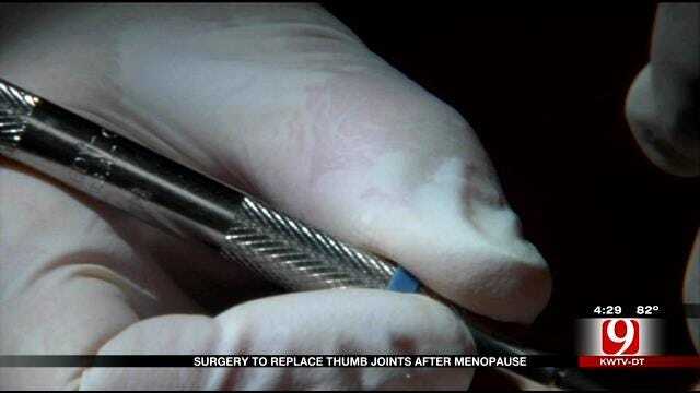 Medical Minute: Surgery To Replace Thumb Joints After Menopause