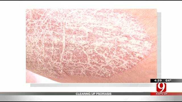 Medical Minute: Causes For Psoriasis