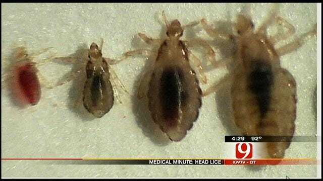 Medical Minute: Head Lice