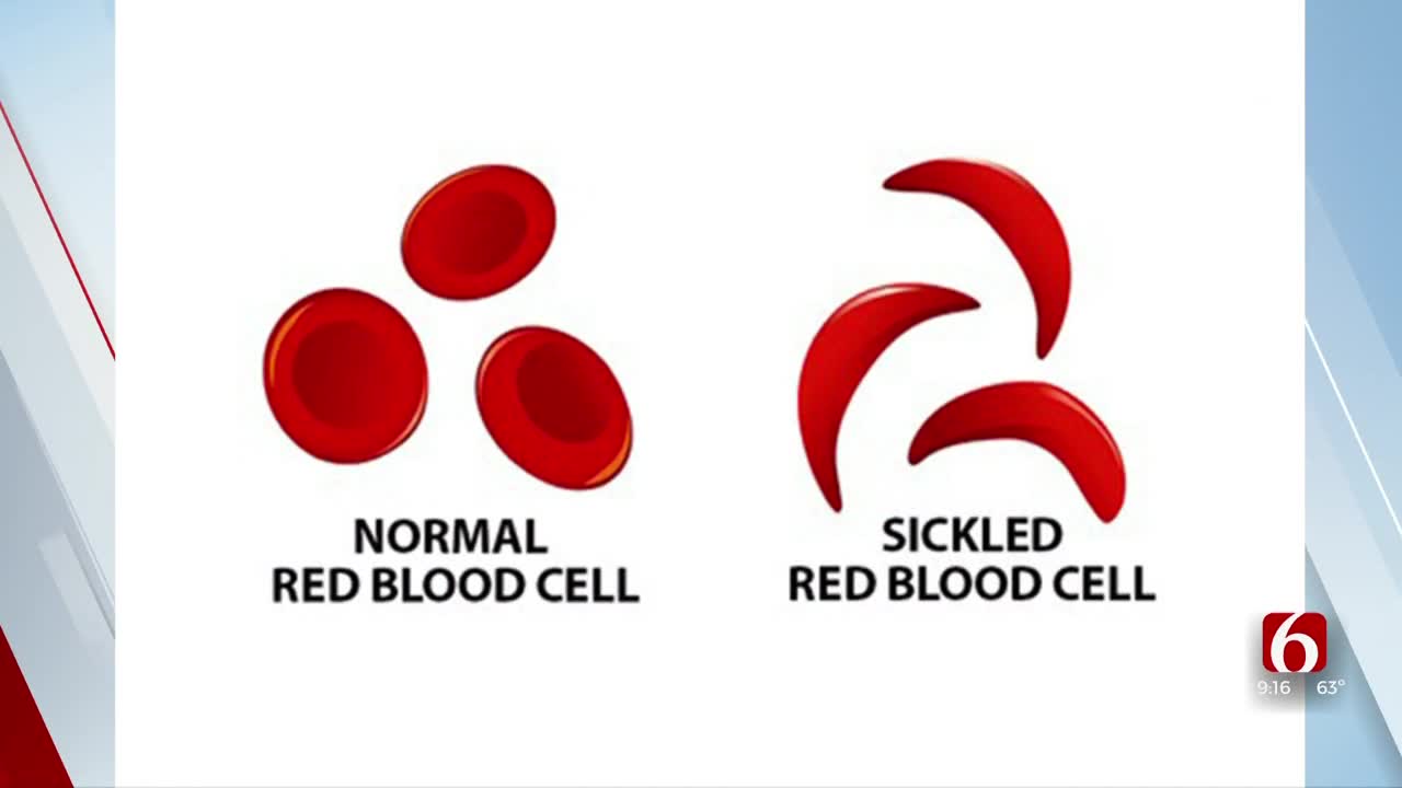 Watch: Dr. Stacy Chronister Discusses Sickle Cell Disease 