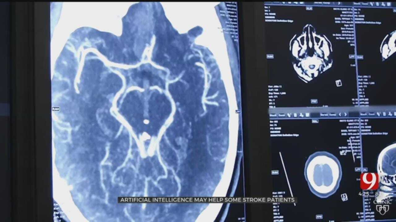 Medical Minute: Artificial Intelligence May Help Some Stroke Patients