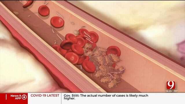 Medical Minute: How To Reverse Heart Disease