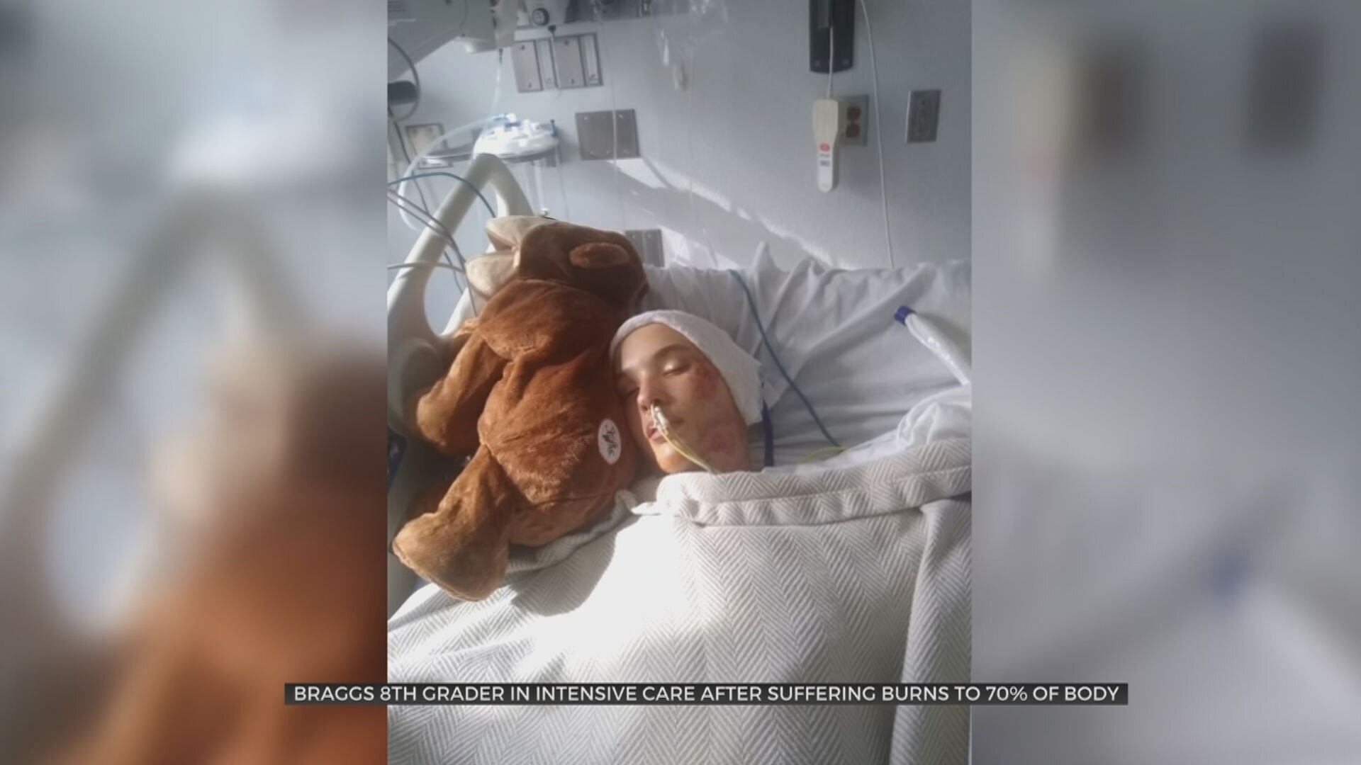 Braggs 8th Grader In ICU After Bonfire Accident Causes Burns To 70% Of Body 