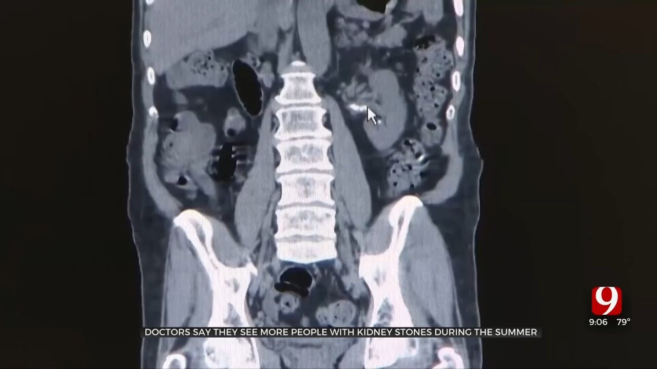 Doctors Give Tips To Avoid Kidney Stones During Summer Season