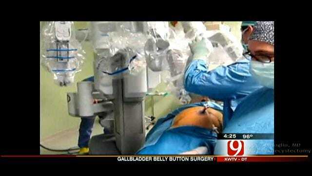 Medical Minute: Gallbladder Belly Button Surgery