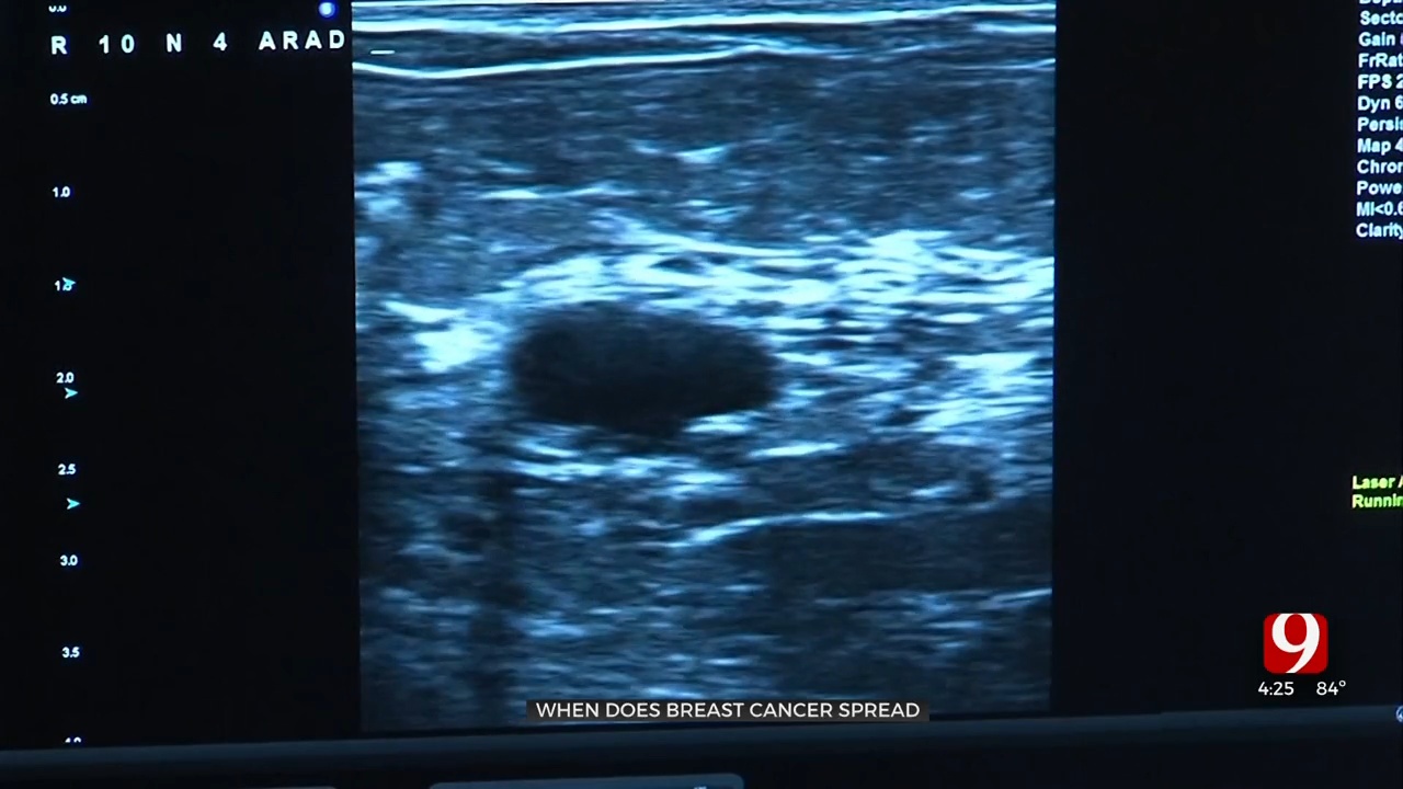 Medical Minute: When Breast Cancer Spreads