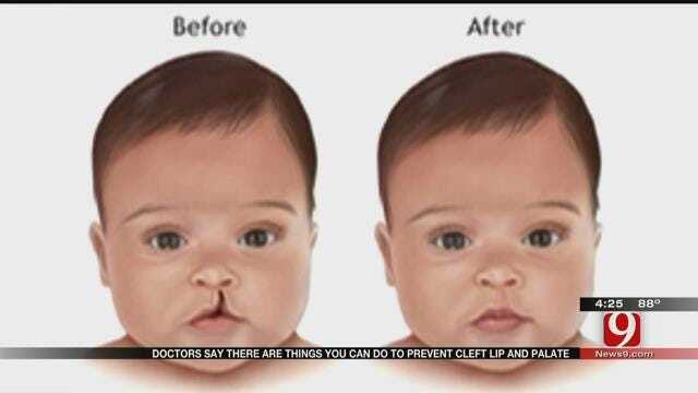 Medical Minute: How To Decrease Chance Of Cleft Lip