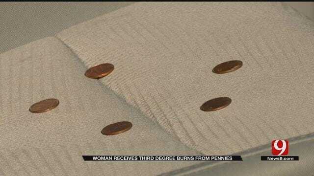 Woman Receives Third Degree Burns From Pennies