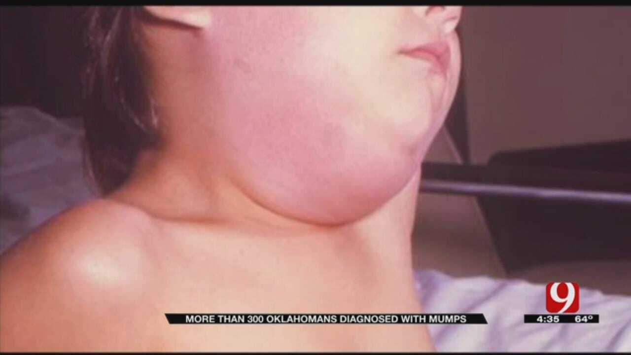 More Than 300 Oklahomans Diagnosed With Mumps