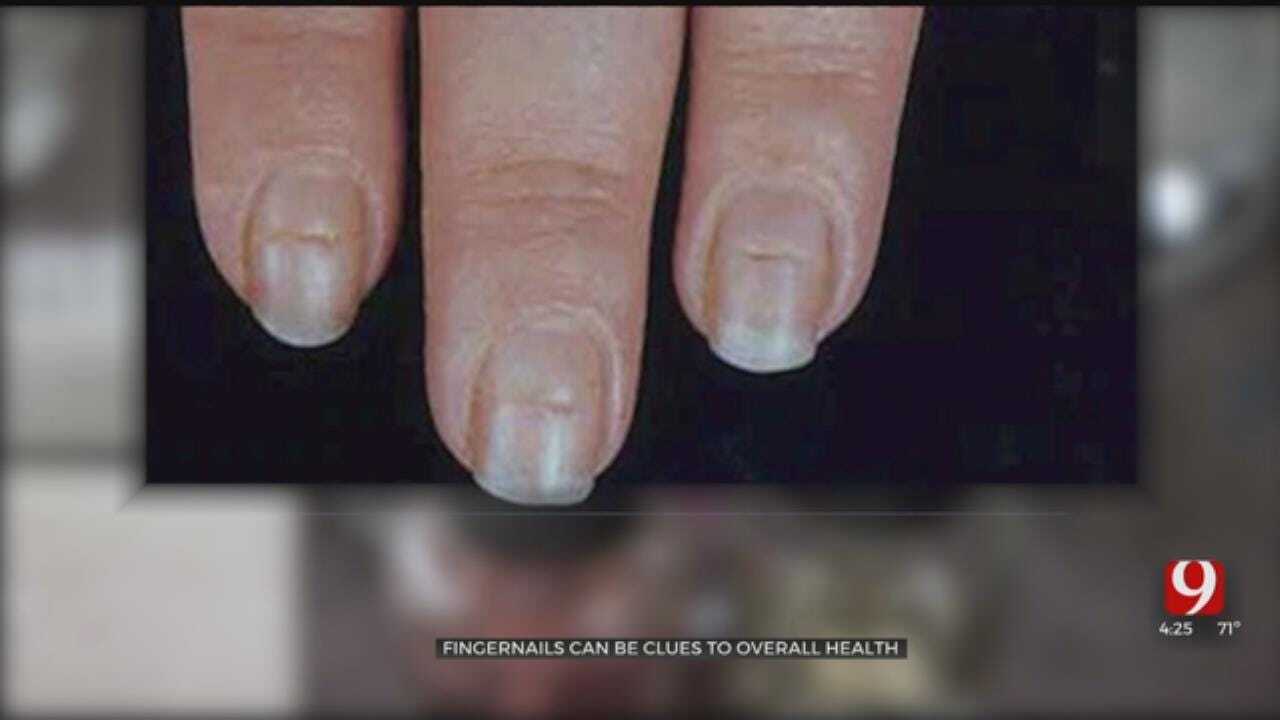 Medical Minute: Fingernails