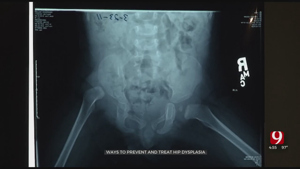 Medical Minute: Ways To Prevent & Treat Hip Dysplasia