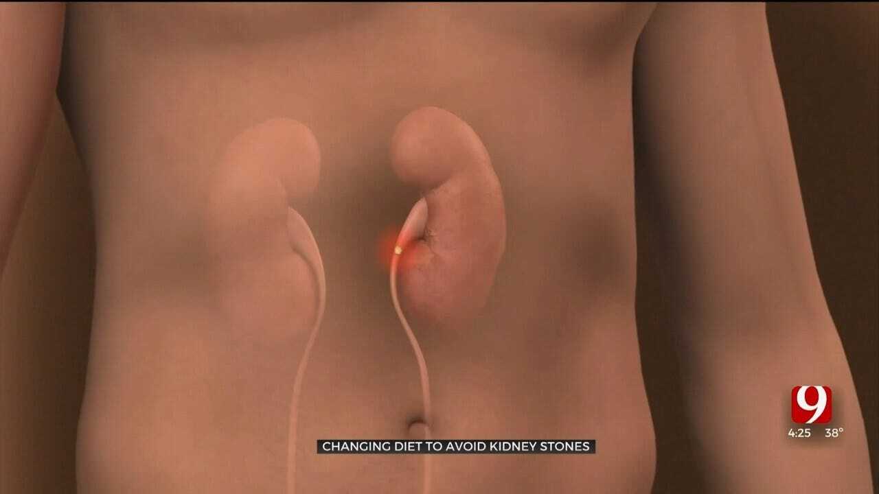 Medical Minute: Reducing Your Chances For Kidney Stones