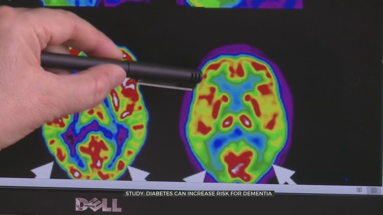 Medical Minute: Diabetes Can Increase Risk For Dementia