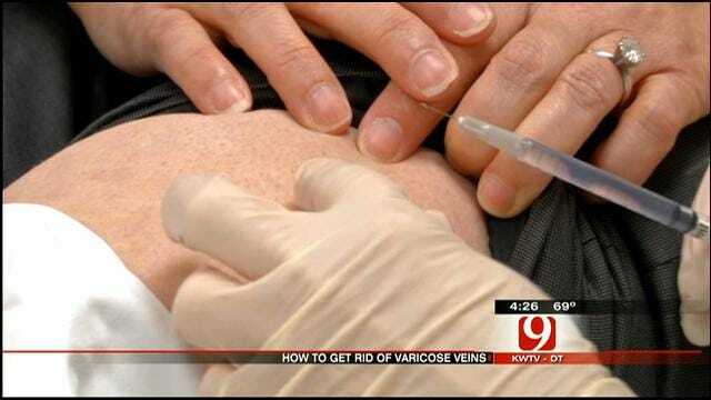 Medical Minute: Getting Rid Of Varicose Veins