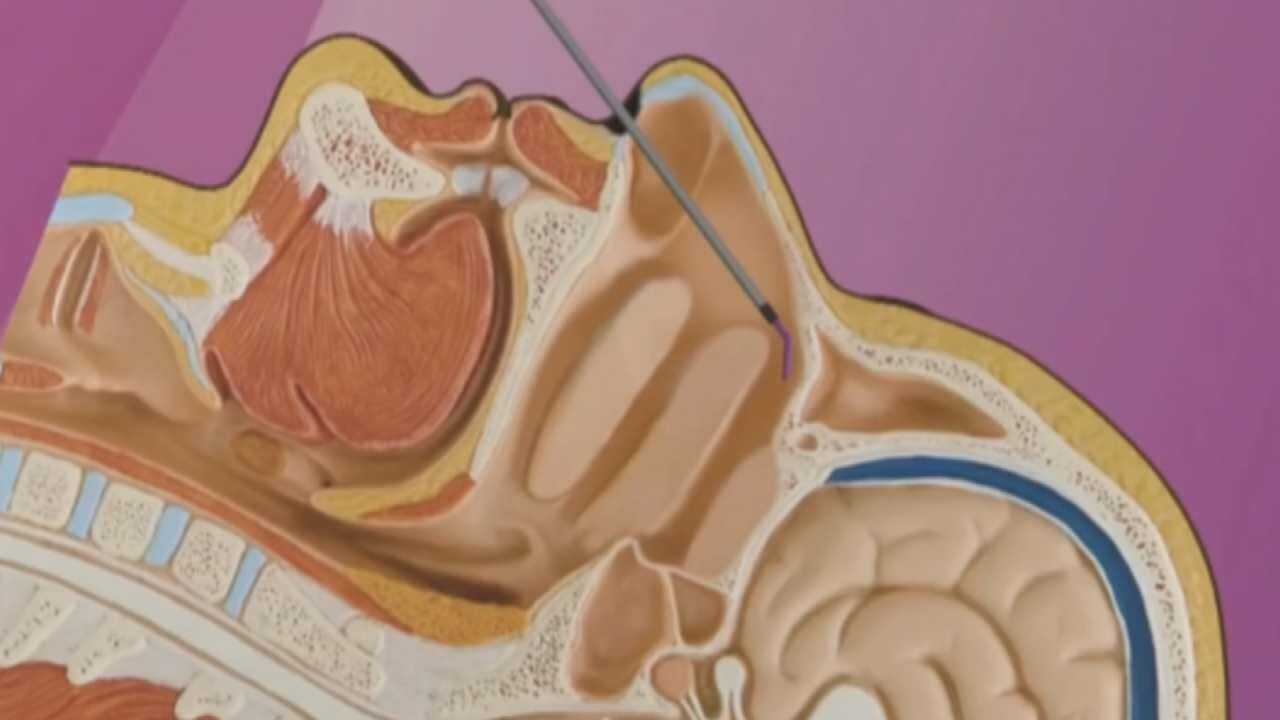 Medical Minute: Treatment Offers Hope For Crippling Migraines