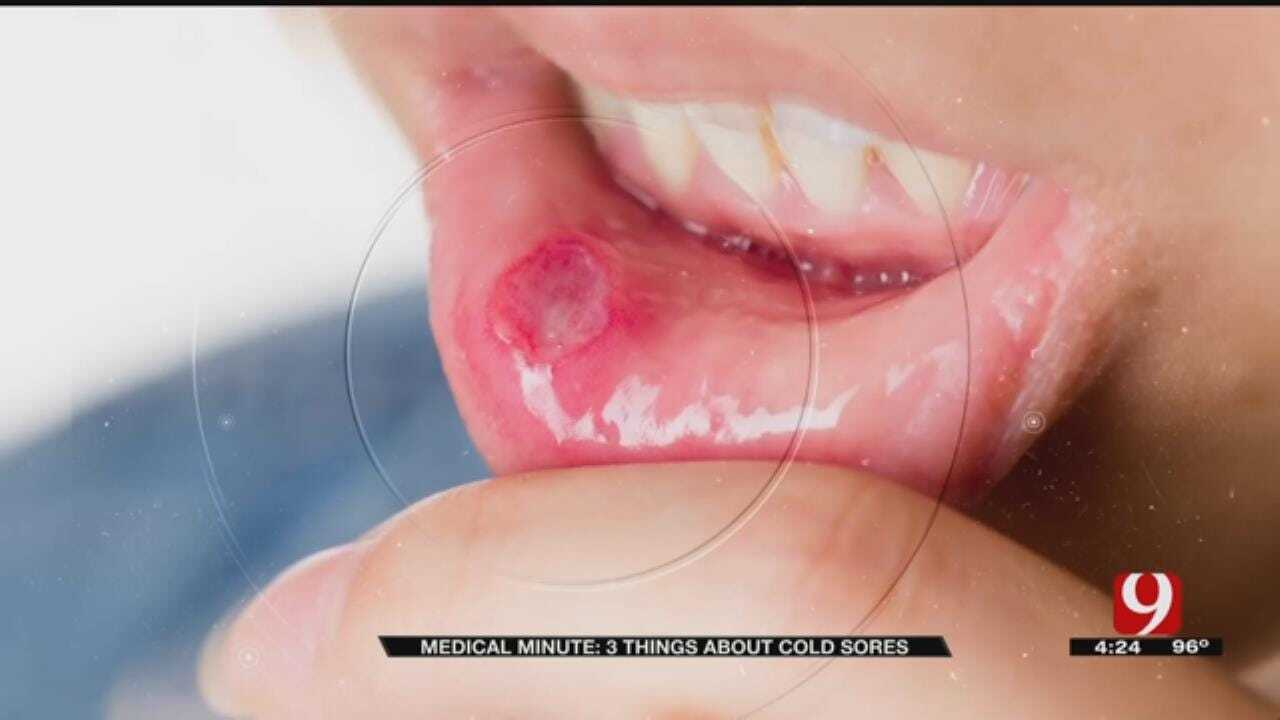 Medical Minute: Cold Sores