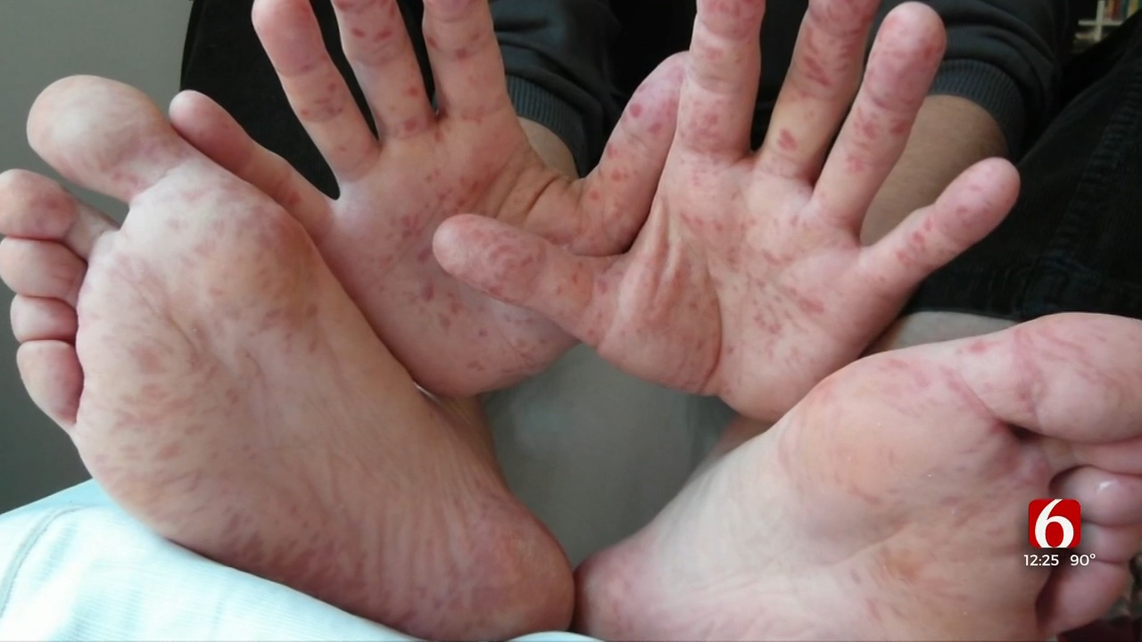 Doctor On Call: Hand, Foot And Mouth Disease