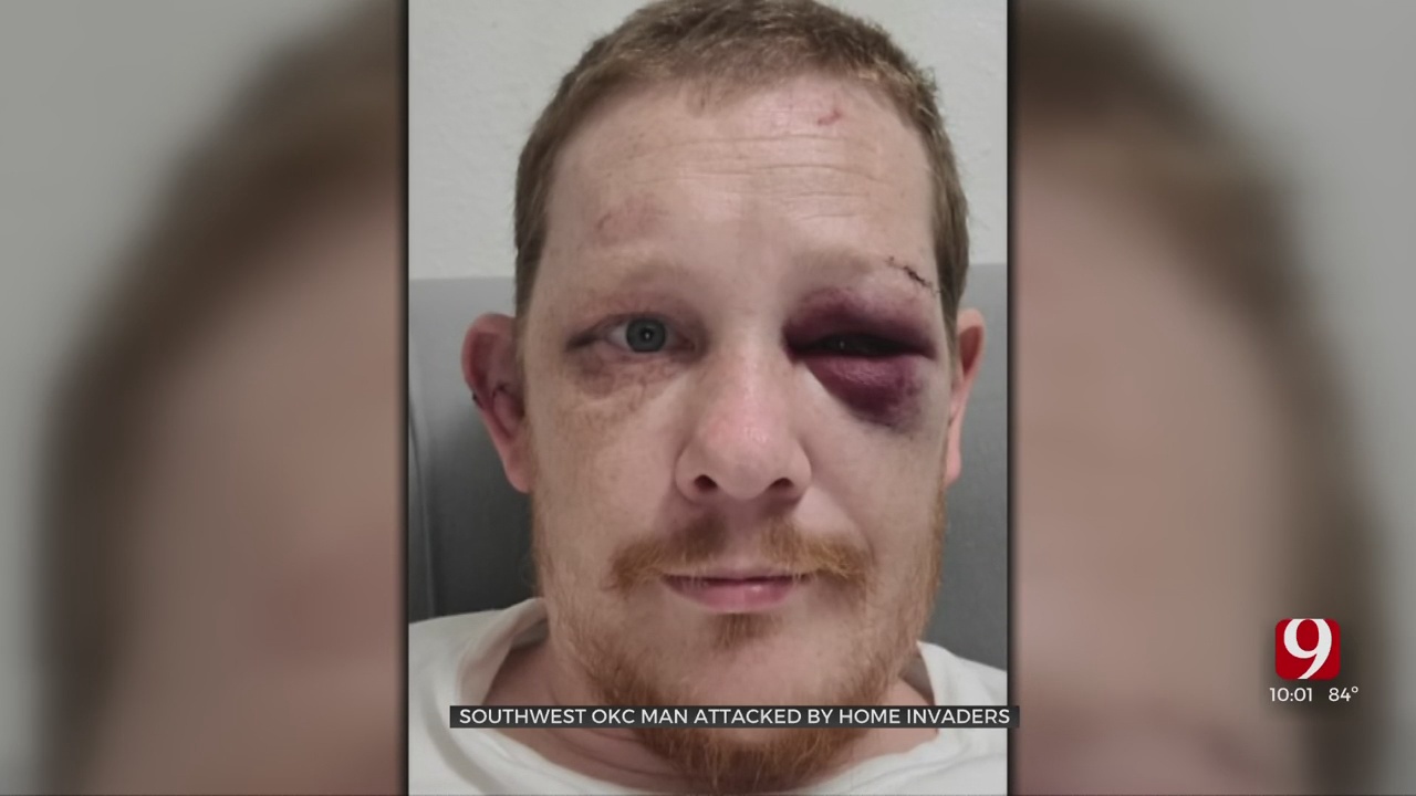 Homeowner Recounts Moments Intruders Beat Him With Gun, Police Looking For Suspects 