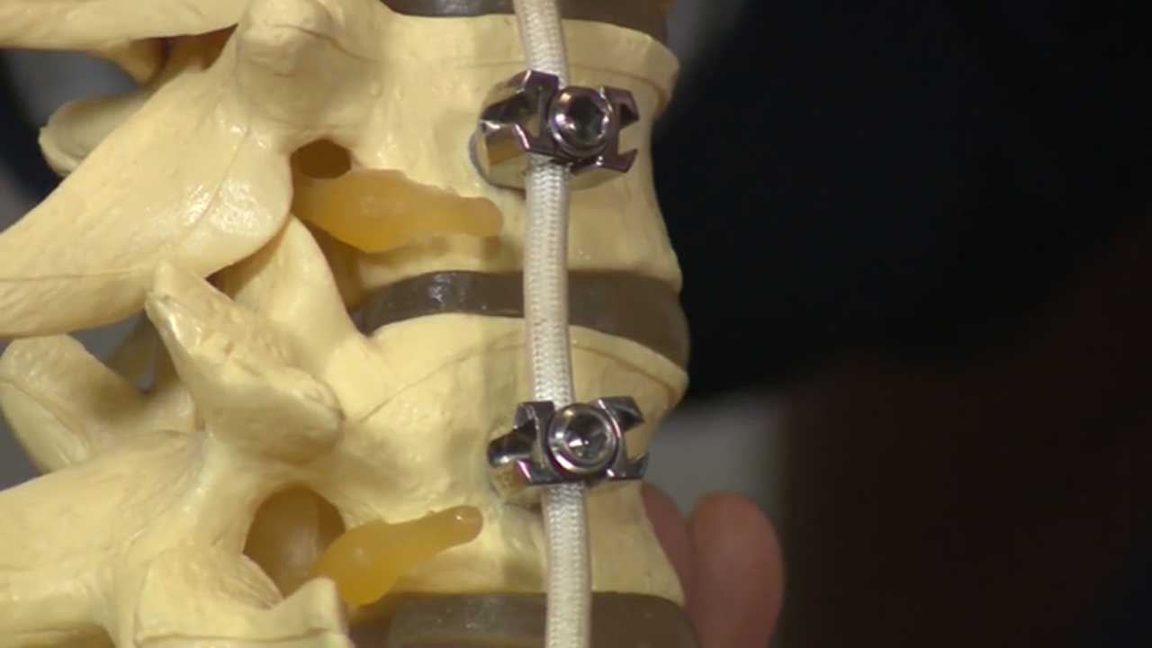 New Surgery Helps Scoliosis Patients Get Back On Their Feet Quicker, Doctors Say