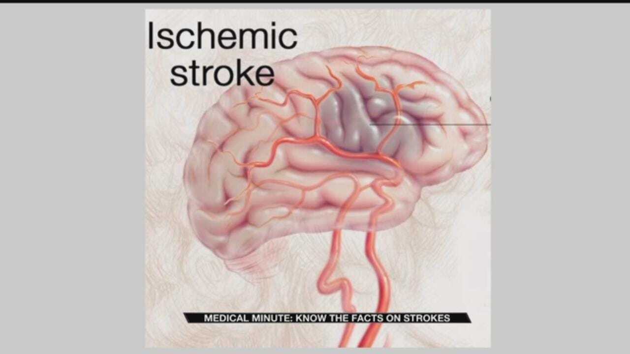 Medical Minute: Stroke Facts