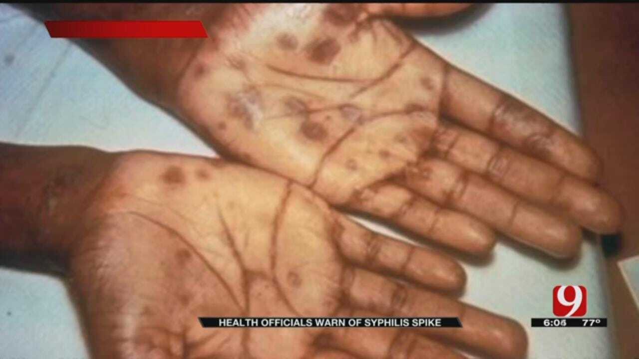 Health Officials Warn Of Syphilis Spike In Oklahoma