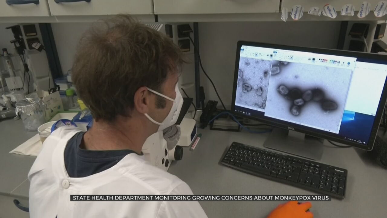 OSDH Monitoring Growing Concerns About Monkeypox