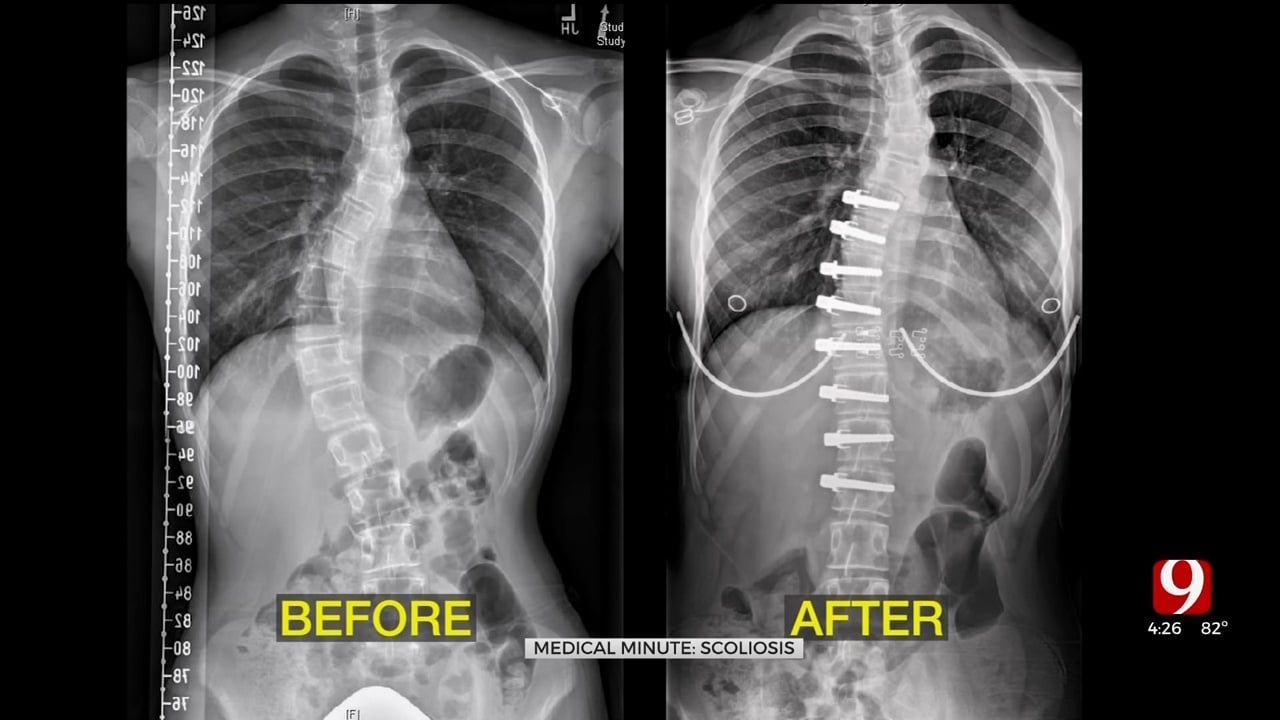 Medical Minute: Adult Scoliosis