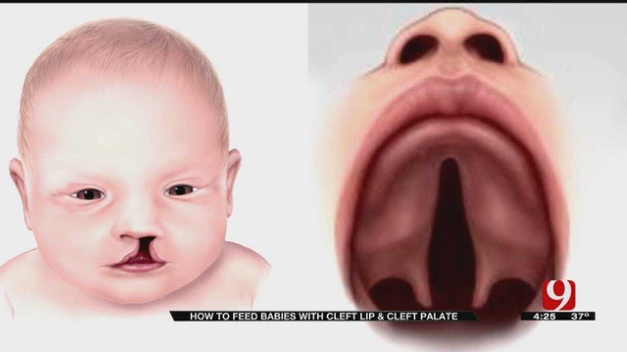 Medical Minute: Cleft Palate