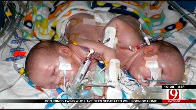 Once Conjoined Twins Still Defying The Odds