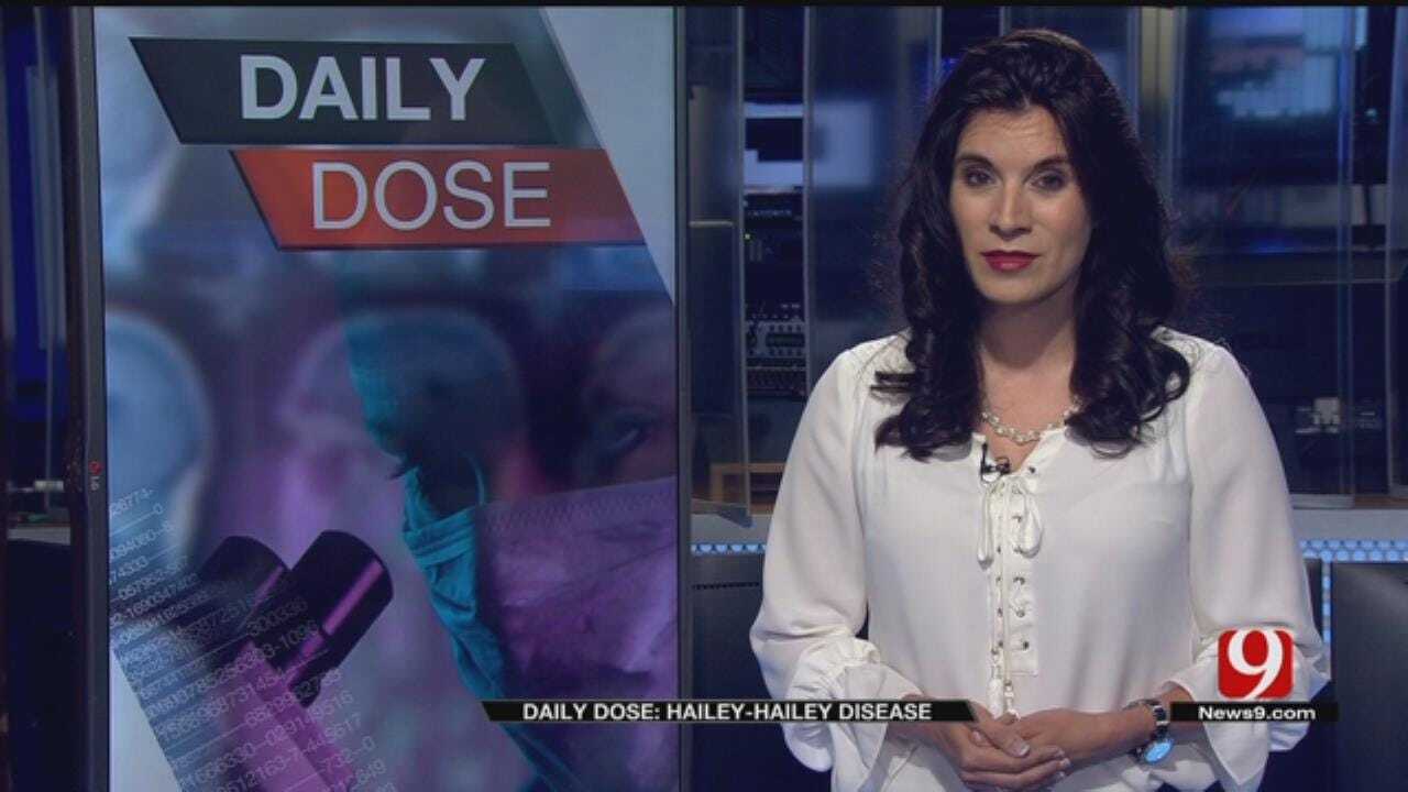 Daily Dose: Hailey-Hailey Disease