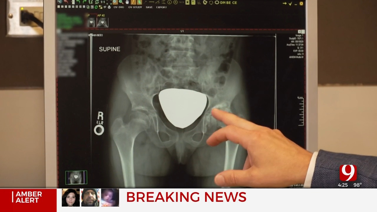Medical Minute: Hip Replacements