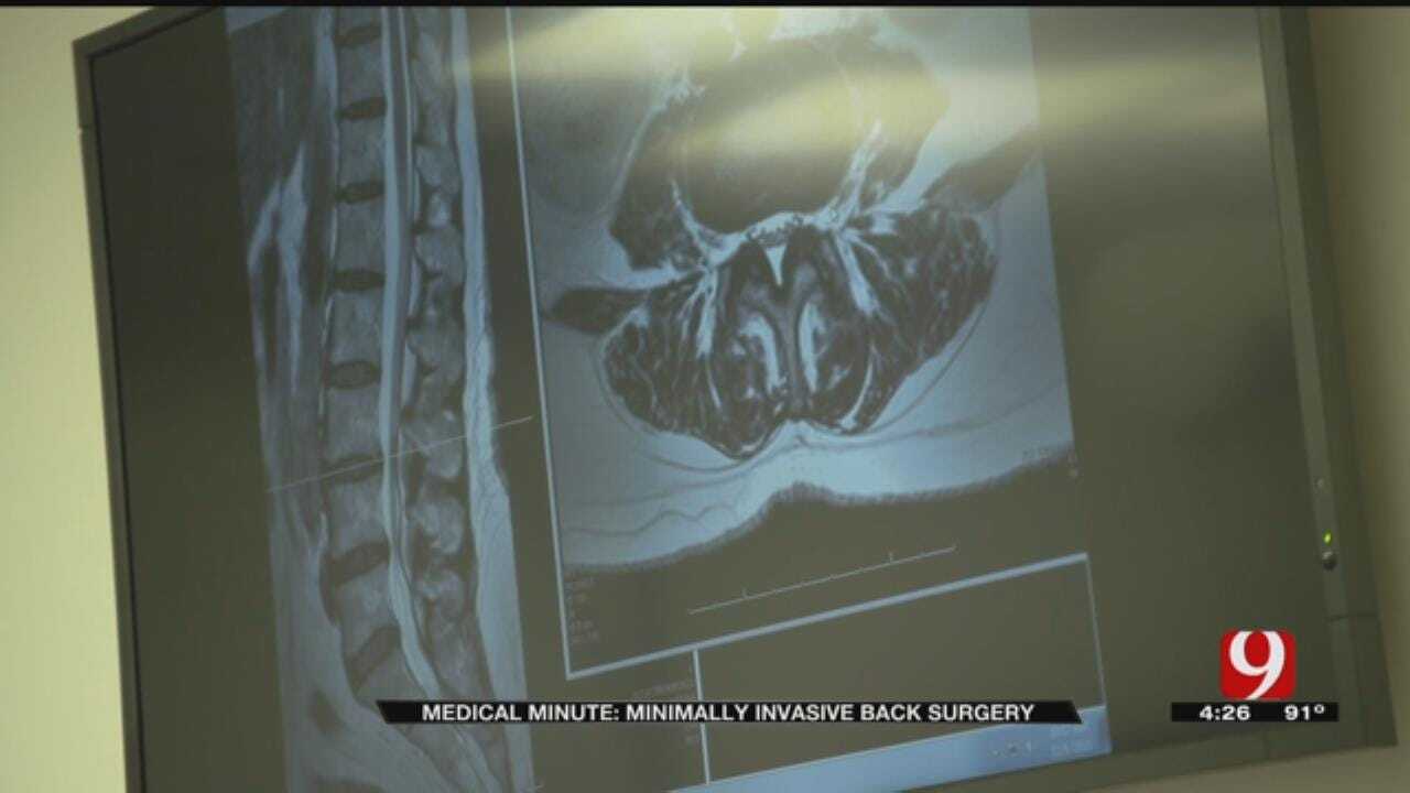 Medical Minute: Innovative Surgery For Back Pain