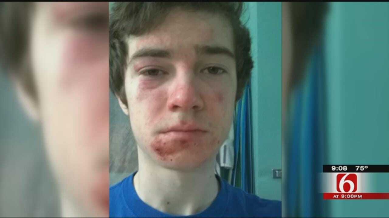 Memorial Student Bruised, Bloody After Out-Of-Hand Pep Rally Skit