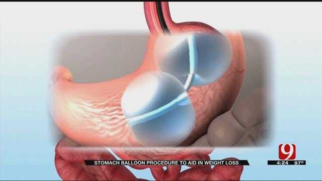 Medical Minute: Stomach Balloons